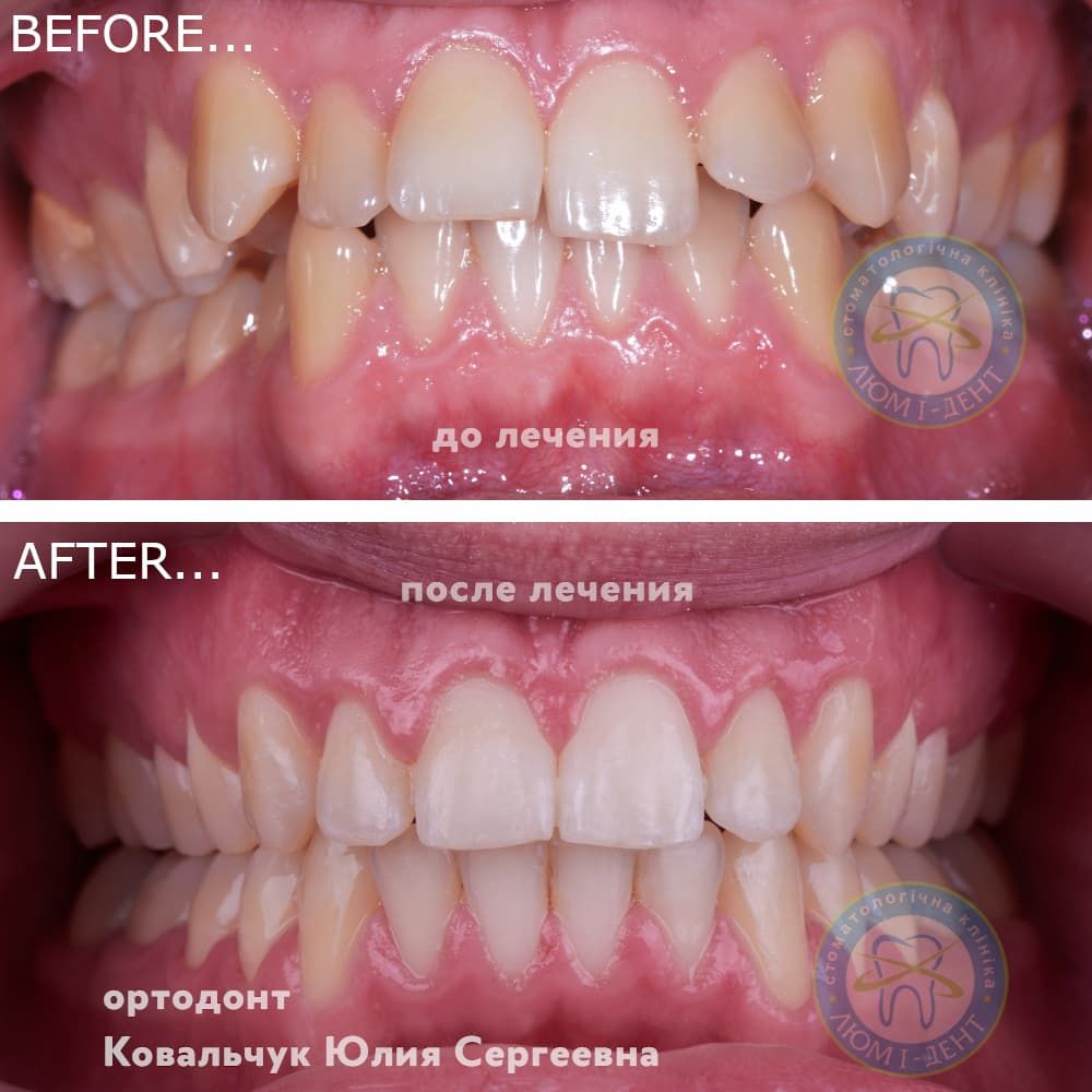 Скільки носять брекети🦷Для виправлення прикусу🦷ЛюміДент